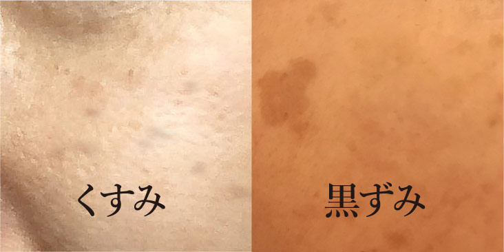 くすみ・黒ずみ